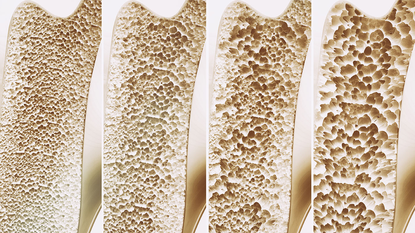 Darstellung des Fortschreitens von Osteoporose anhand von vier nebeneinander liegenden Querschnitten eines Knochens. Links gesunder Knochen mit dichter Struktur, rechts zunehmend poröser werdender Knochen mit größer werdenden Hohlräumen.